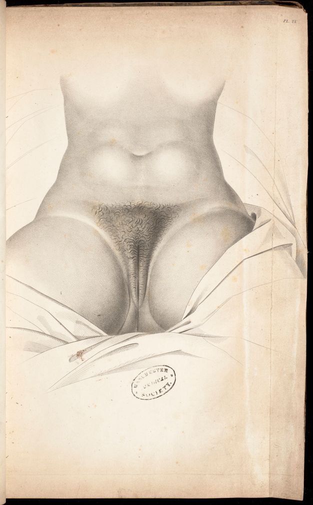 Illustration. A woman’s lower torso to upper thighs is shaded in detail. She sits facing us, legs spread and her labia closed under pubic hair in this black and white lithograph.
