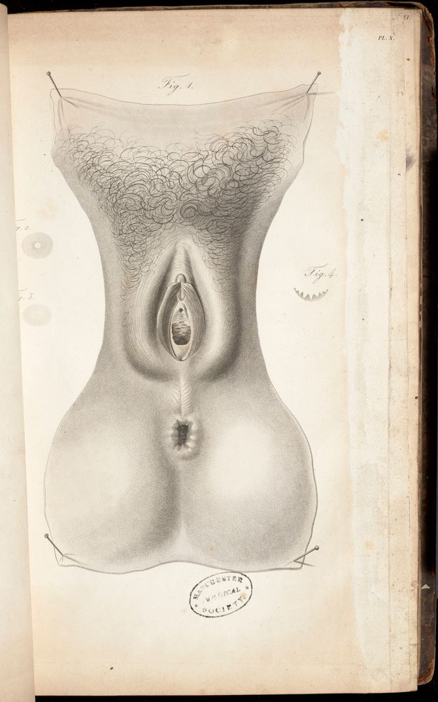 Illustration. A woman’s groin from the pubic hair to anus has been cut away and pinned to a blank background. The labia are open in this black and white lithograph.