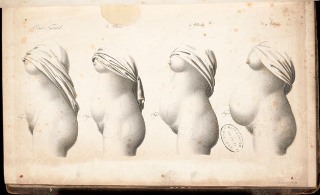 Illustration. The torso of a woman from breasts to groin is repeated four times, showing the progression of a pregnancy in the belly and changes to the breasts in this black and white lithograph.