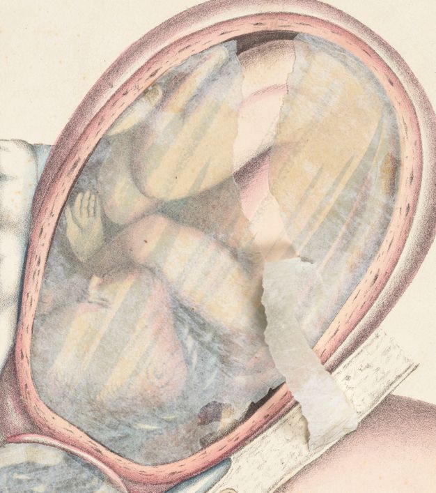 Lithograph. Detail view of a baby in utero. The coloured illustration is covered by a piece of tissue paper, which has been torn down the middle.