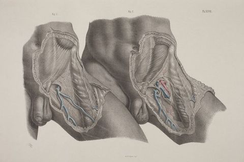 Illustration. The left lower abdomens, hips, and upper thighs of two men are shown from just above the belly button to mid-thigh. The dissected thigh of the left person overlaps the untouched thigh of the other. The example on the right shows deeper dissections, and a few parts are coloured in red and blue in both.