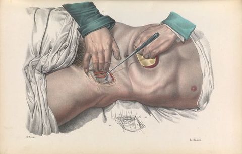 Illustration. This colour lithograph shows two hands working in and around an incision in a man’s pelvis next to the groin. One hand holds back the abdomen and the first three fingers of the other pull the incision open. A diagram of the incision is in black and white below.