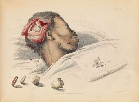 Illustration. A hand-coloured print shows a Black man’s face turned away from us. The skin of his skull has been cut and folded back. The bones within show the round cut of a trephine. Pieces of bone are drawn below. The original fracture is sketched on a piece of paper within the print.