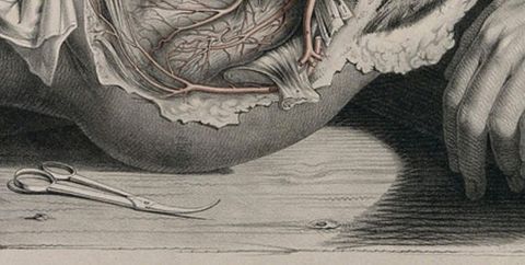 Illustration. Detail view of a pair of scissors with long handles and short blades that curve upwards. They rest on a wood table shared by the buttock and hand of a woman whose abdomen and pelvic area have been dissected.
