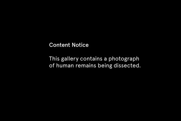 Slide reads: “This gallery of images contains photographs of human remains being dissected.”