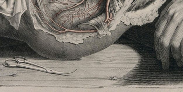 Illustration. Detail view of a pair of scissors with long handles and short blades that curve upwards. They rest on a wood table shared by the buttock and hand of a woman whose abdomen and pelvic area have been dissected.
