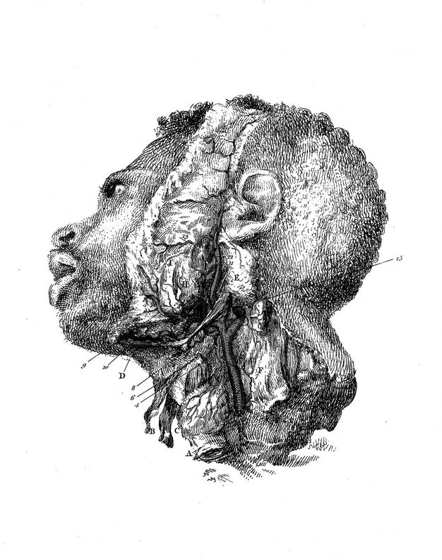 Illustration. The head of a Black man tips slightly away from us and is in profile view. The side of the head and neck have been dissected, the skin folded back.