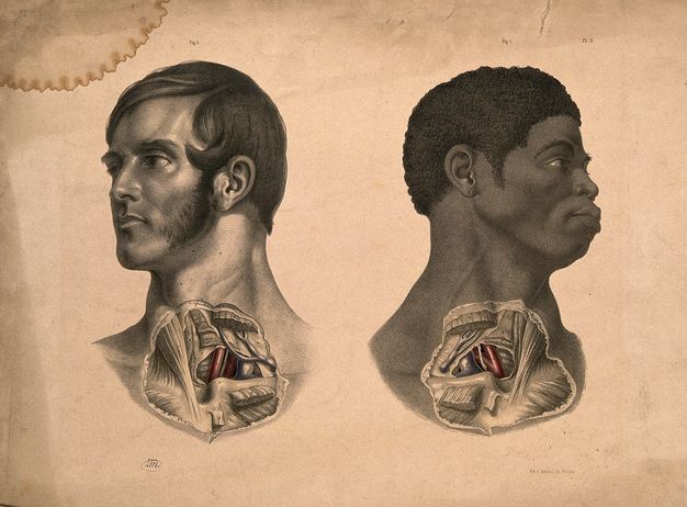 Illustration. Roughly round patches of skin covering the lower neck head and upper chest of two men, one white and one Black, are removed to show muscles, organs, and tissues. The white man is to our left, and his open eyes look in that direction. The Black man is to our right, eyes also following that direction. The exposed organs are mirrored.