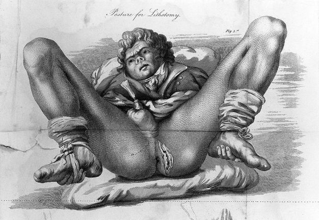Illustration. A man lies on his back with his knees deeply bent so his hands are tied to and cradle his feet. His penis is tucked into a bag, and the man’s necktie and coat push up around his chin. He looks up and to our left under a furrowed brow. A vertical incision is near the rectum.