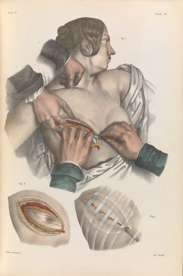 Illustration. This colour lithograph shows a pale-skinned woman looking off to our right, mouth pinched closed, as two sets of hands slice into her right breast. Insets below show the layers within the breast and how the wound should be closed.
