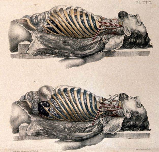 Illustration. Two profile views of men lying with their torso on slightly elevated boards. The skin has been removed and pulled back from the rib cages and abdomens. The illustration below shows a swelling in the lower abdomen and expansion of the lower ribs. A device has been put into the windpipe in the lower cadaver.