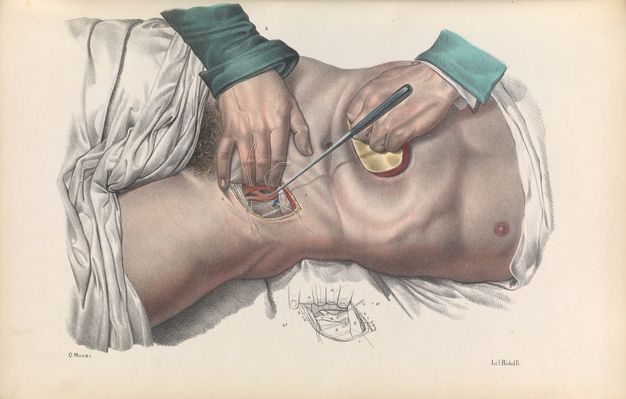 Illustration. This colour lithograph shows two hands working in and around an incision in a man’s pelvis next to the groin. One hand holds back the abdomen and the first three fingers of the other pull the incision open. A diagram of the incision is in black and white below.