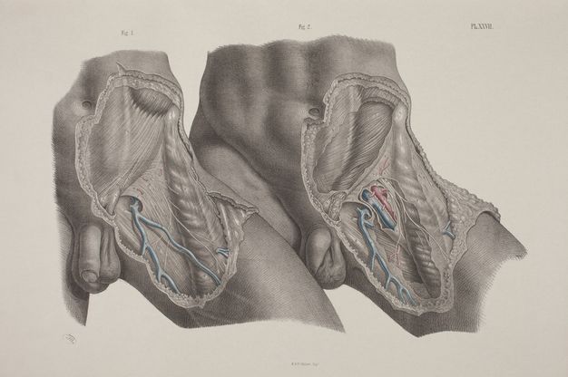 Illustration. The left lower abdomens, hips, and upper thighs of two men are shown from just above the belly button to mid-thigh. The dissected thigh of the left person overlaps the untouched thigh of the other. The example on the right shows deeper dissections, and a few parts are coloured in red and blue in both.