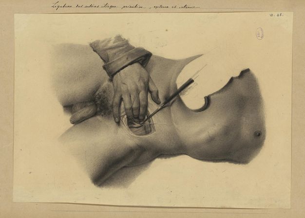 Drawing. In tones of smoky grey, one hand works in an incision in a man’s pelvis. The first three fingers hold open the incision so a probe can be used. The thumb and pinkie finger rest lightly on the flesh, the pinkie near the pubic hair. A blank area is left in the torso for the surgeon’s other hand to be drawn.