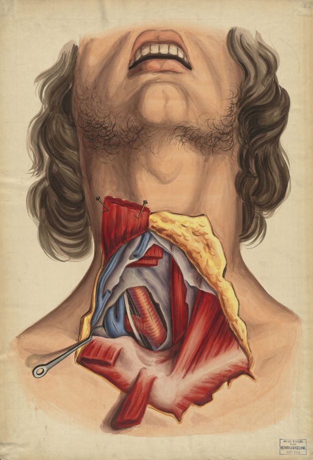 Watercolour. A man’s head is angled steeply back to expose his neck, which is dissected from below the Adam’s apple to the clavicle. The skin is peach coloured, his open lips pink, and hair brown. Pins hold open scarlet-red muscles. The underside of the skin is yellow, the vessels blue and red.