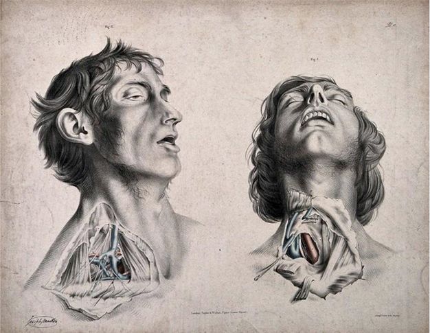 Illustration. Two men are shown from the shoulders up, each with their throat and neck dissected. Both are clean shaven with mutton chops, and their mouths are open. The man on our left is shown almost in profile facing our right, his eyes half open and his face slack. We look onto the underside of the other man’s chin as his head falls far back. His eyes are closed.